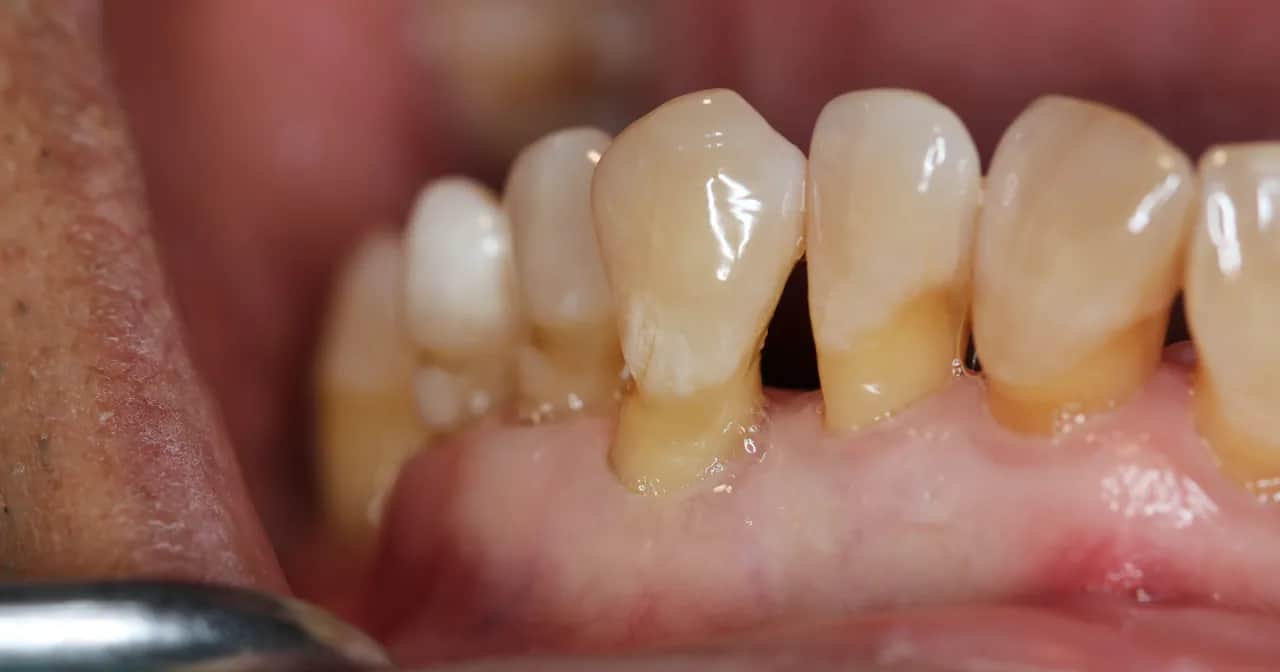 Recesja dziąseł: Jak zatrzymać i odbudować utraconą tkankę?