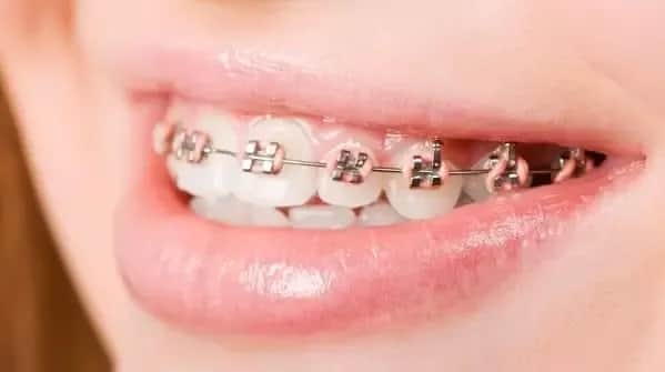 Aparaty na zęby: Jaki wybrać? Typy, koszty, dyskrecja.