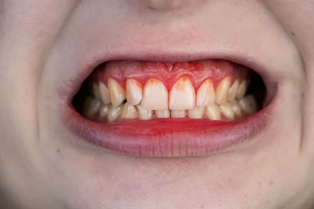 Koniec z krwawieniem! Jak mieć zdrowe dziąsła? Poradnik