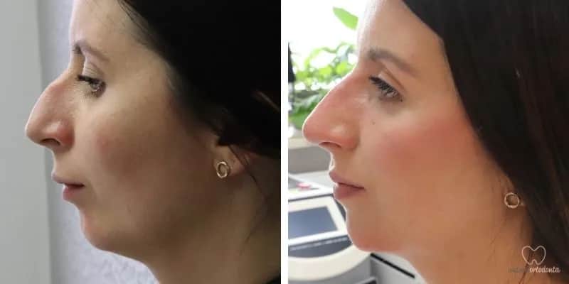 Czy aparat zmieni Twoją twarz? Rysy, profil, broda po leczeniu.