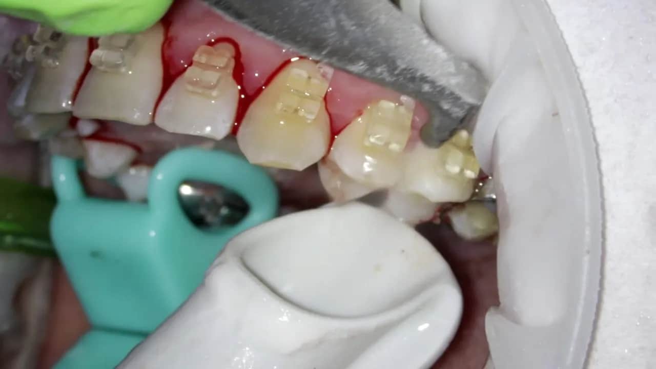 Skaling zębów: Ile trwa zabieg i od czego zależy jego czas?