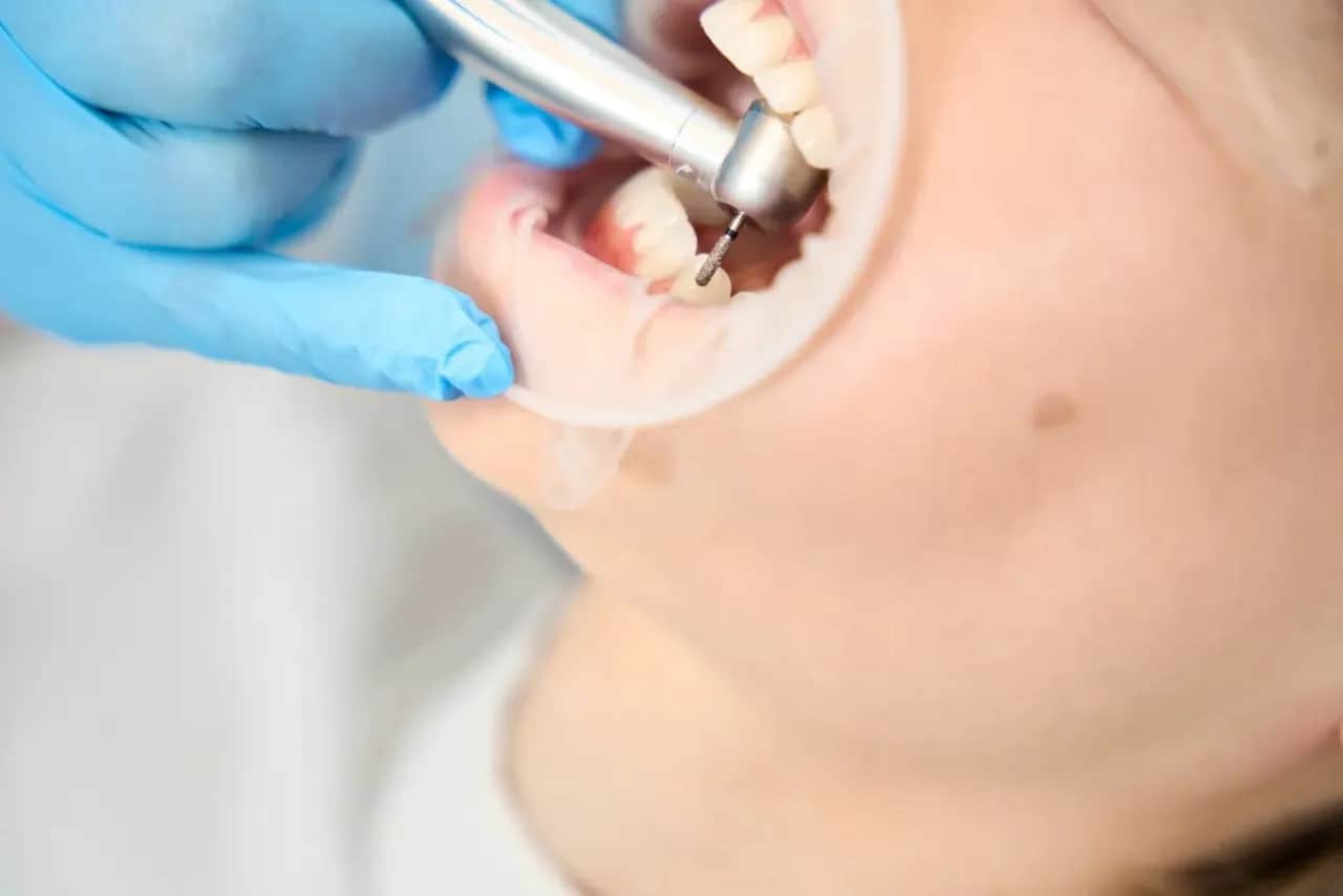 Co dentysta wkłada w zębodół po ekstrakcji? Wszystko, co musisz wiedzieć