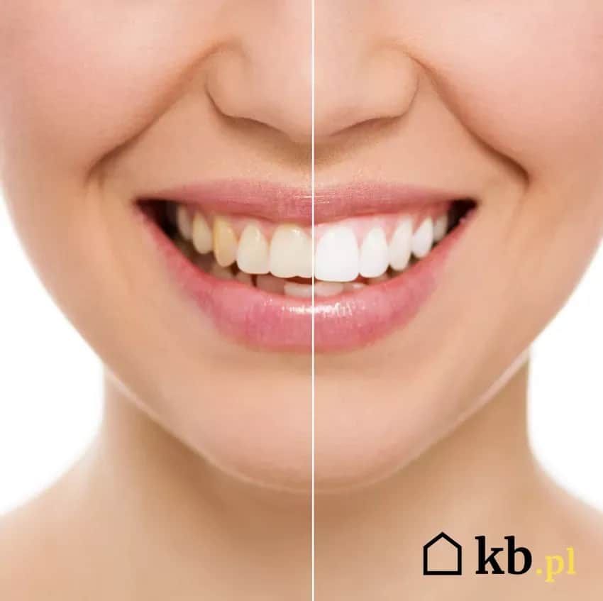 Wybielanie zębów: Ile kosztuje? Poznaj ukryte koszty!
