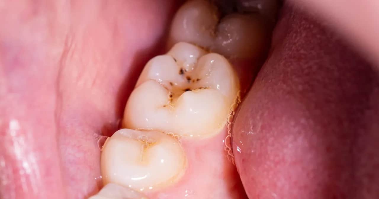 Jak wyleczyć próchnicę w domu? Kiedy to możliwe, a kiedy musisz iść do dentysty?