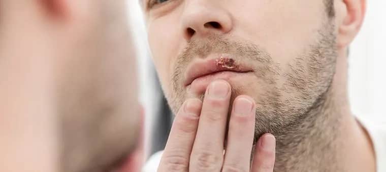 Rany w ustach? Szybka ulga i skuteczne leczenie. Porady eksperta.