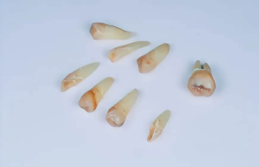 Czym płukać usta po wyrwaniu zęba? Uniknij suchego zębodołu!