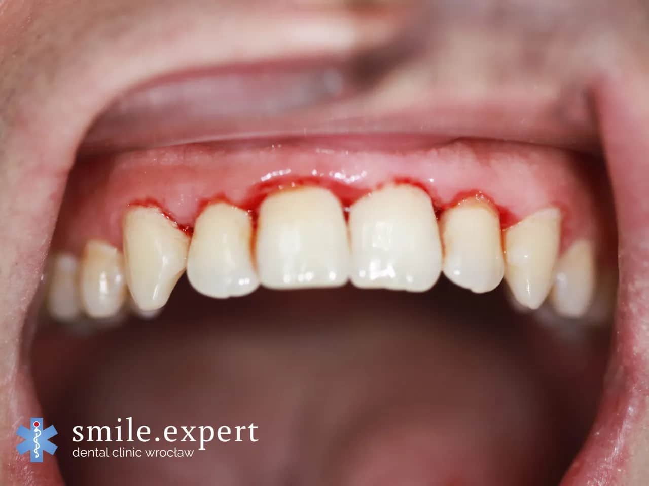 Ból dziąseł? Leki, płukanki, domowe metody kompleksowy przewodnik