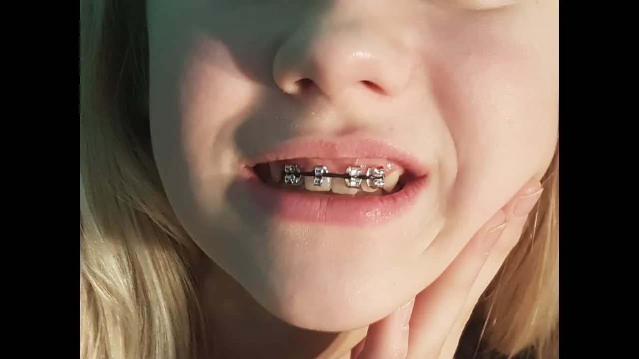 DIY sztuczny aparat na zęby: Jak zrobić bezpieczny rekwizyt?