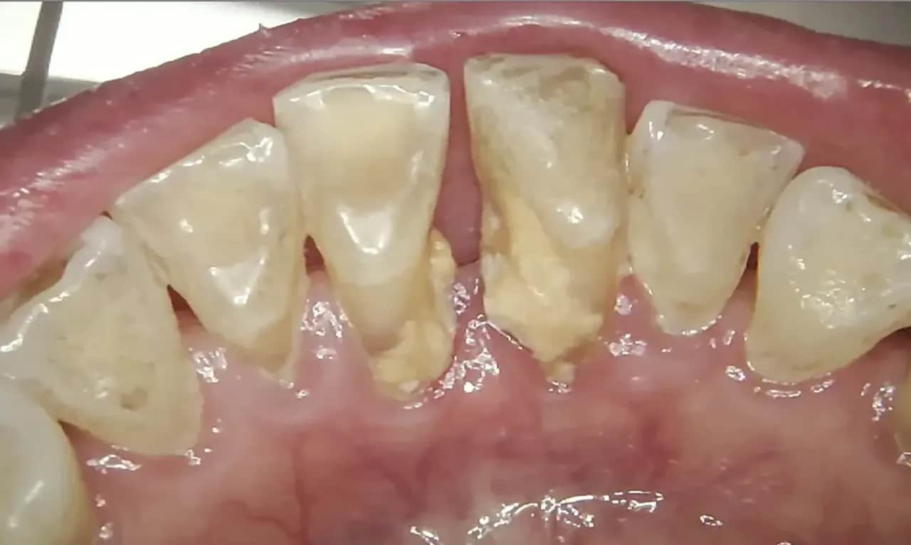 Dziąsło odchodzi od zęba? Co robić, by uratować uśmiech!